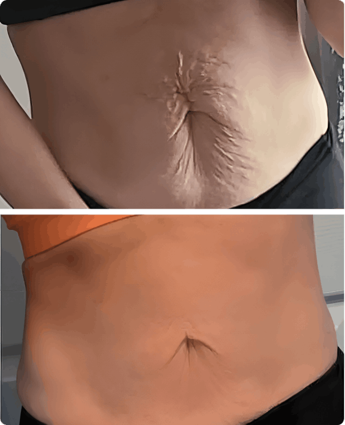 Glokore IPL Body Sculptor customer review Michelle D.